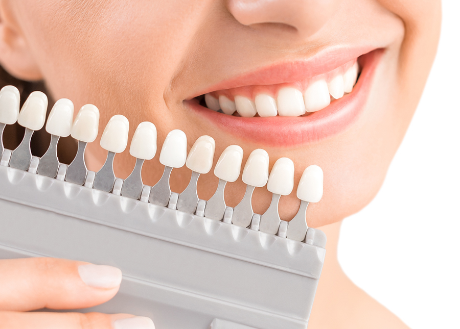 teeth whitening te awamutu